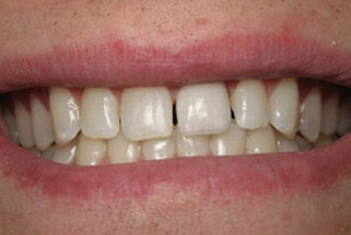 After Invisalign-100